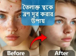 তৈলাক্ত ত্বকে ব্রণ দূর করার উপায়