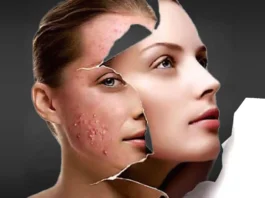 acne-treatment-tips