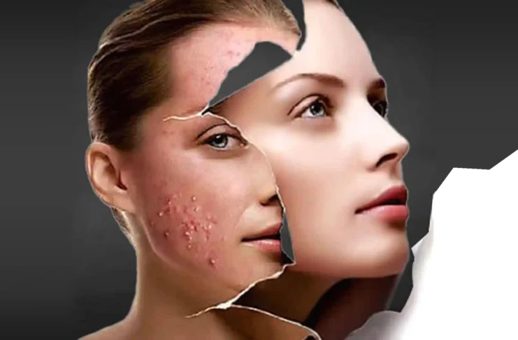 acne-treatment-tips